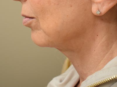 Chin Augmentation Before & After Gallery - Patient 353498 - Image 2