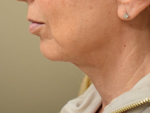 Chin Augmentation Before & After Gallery - Patient 353498 - Image 2