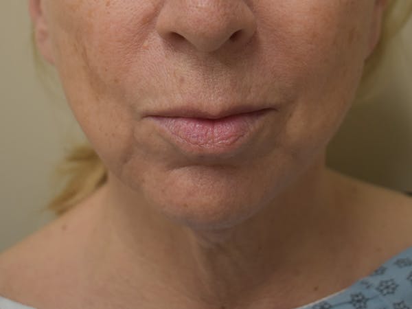 Chin Augmentation Before & After Gallery - Patient 353498 - Image 3