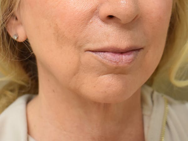 Chin Augmentation Before & After Gallery - Patient 353498 - Image 4