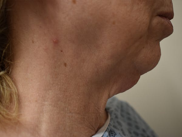 Chin Augmentation Before & After Gallery - Patient 353498 - Image 5