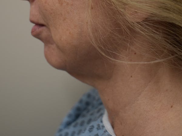 Chin Augmentation Before & After Gallery - Patient 353498 - Image 1