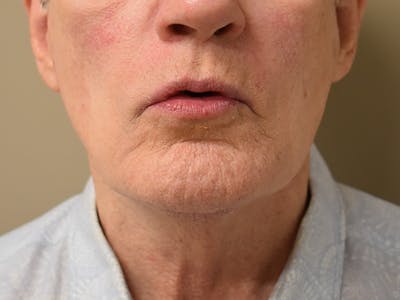 Chin Augmentation Before & After Gallery - Patient 134870 - Image 4