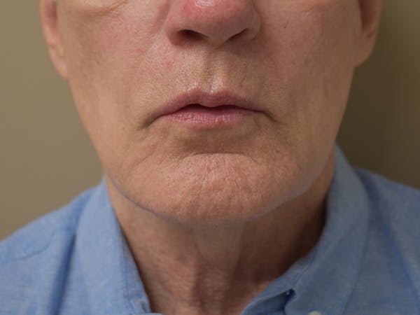 Chin Augmentation Before & After Gallery - Patient 134870 - Image 3