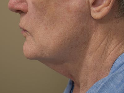 Chin Augmentation Before & After Gallery - Patient 134870 - Image 1