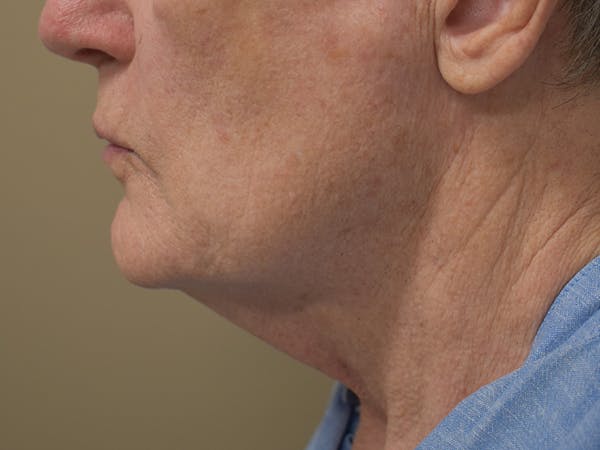 Chin Augmentation Before & After Gallery - Patient 134870 - Image 1
