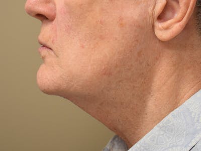 Chin Augmentation Before & After Gallery - Patient 134870 - Image 2