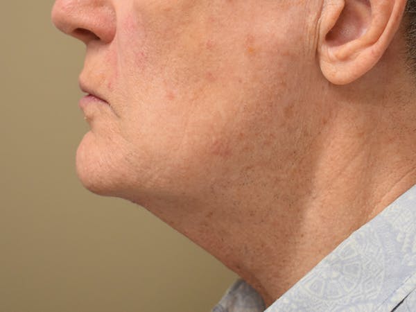 Chin Augmentation Before & After Gallery - Patient 134870 - Image 2