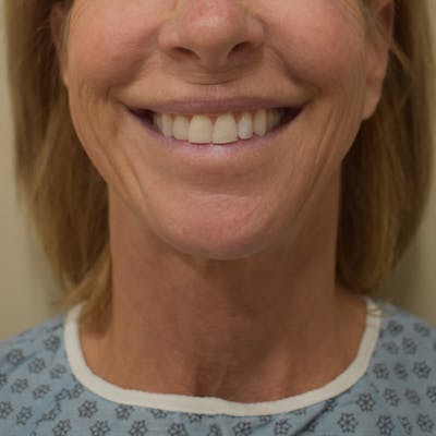 Co2 Laser Resurfacing Before & After Gallery - Patient 104311 - Image 1
