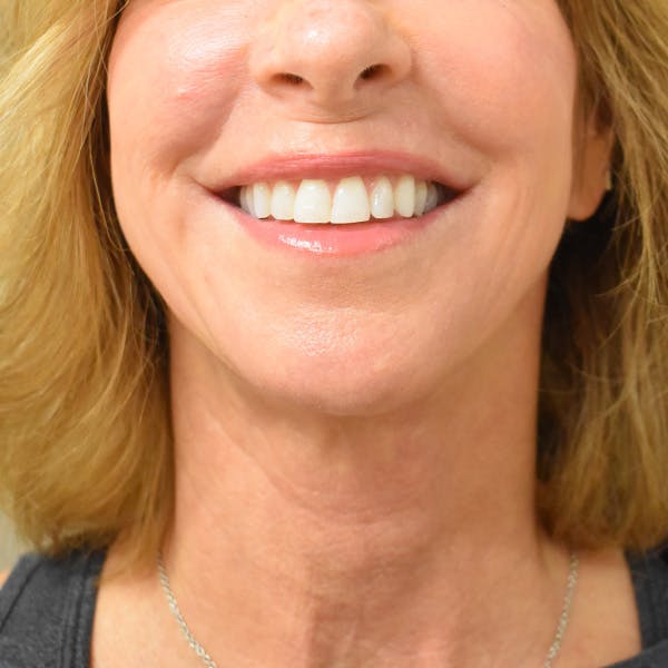 Co2 Laser Resurfacing Before & After Gallery - Patient 104311 - Image 2