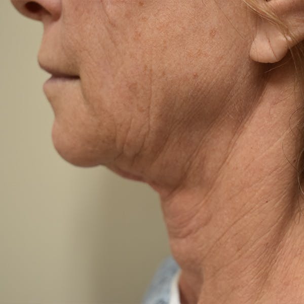 Co2 Laser Resurfacing Before & After Gallery - Patient 104311 - Image 3