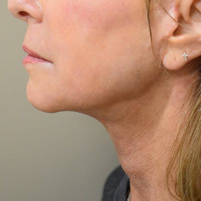 Co2 Laser Resurfacing Before & After Gallery - Patient 104311 - Image 4