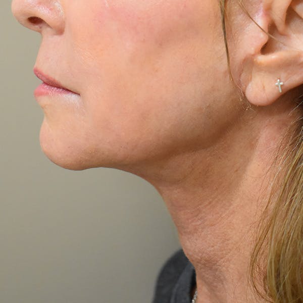 Co2 Laser Resurfacing Before & After Gallery - Patient 104311 - Image 4