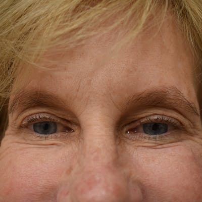 Eyelid Surgery Before & After Gallery - Patient 480292 - Image 1