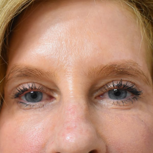 Co2 Laser Resurfacing Before & After Gallery - Patient 104311 - Image 6