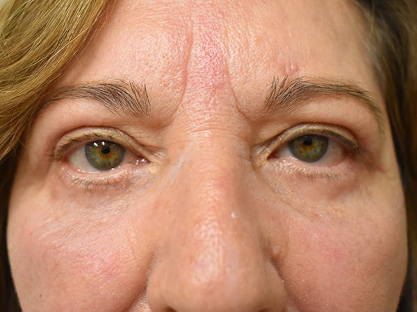Eyelid Surgery Before & After Gallery - Patient 196660 - Image 2