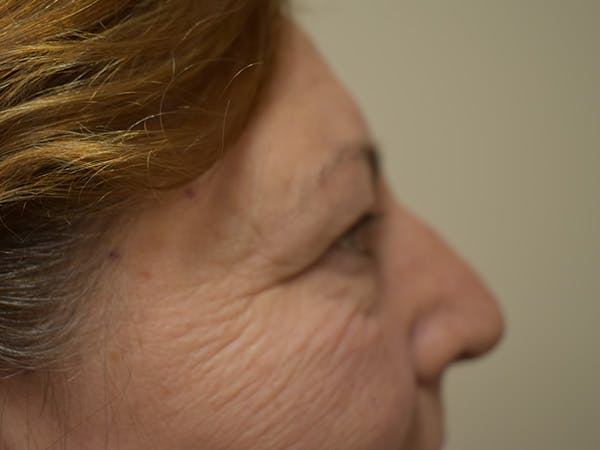 Eyelid Surgery Before & After Gallery - Patient 196660 - Image 3