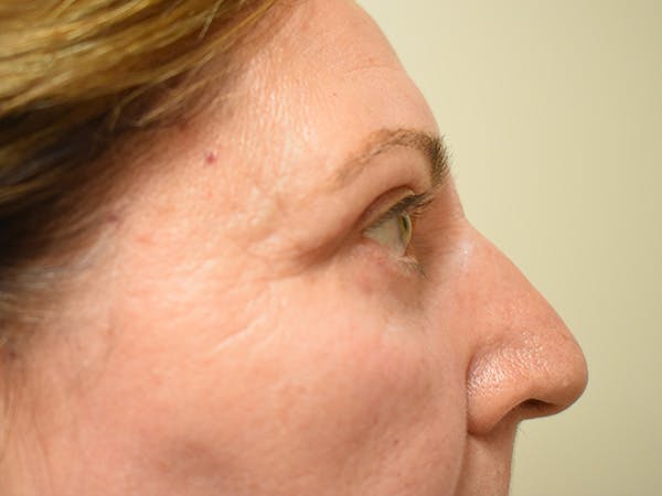 Eyelid Surgery Before & After Gallery - Patient 196660 - Image 4