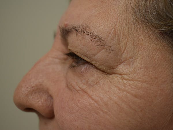 Eyelid Surgery Before & After Gallery - Patient 196660 - Image 5