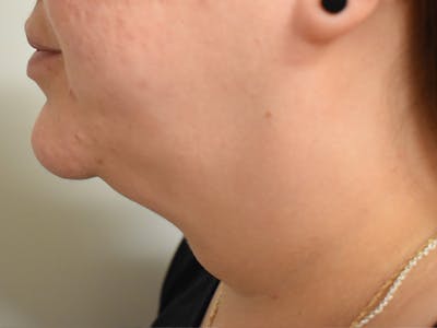 Chin Augmentation Before & After Gallery - Patient 131125 - Image 2