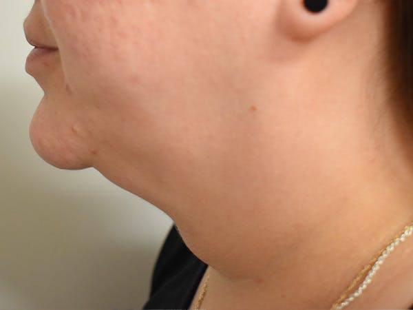 Chin Augmentation Before & After Gallery - Patient 131125 - Image 2