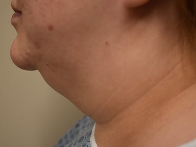 Chin Augmentation Before & After Gallery - Patient 131125 - Image 1