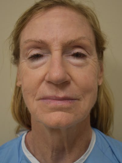 Facelift Before & After Gallery - Patient 312653 - Image 1