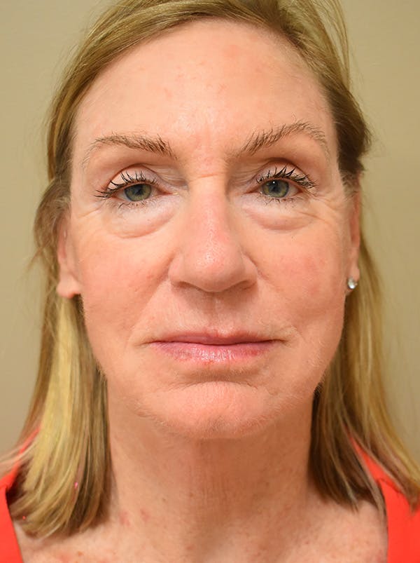 Facelift Before & After Gallery - Patient 312653 - Image 2