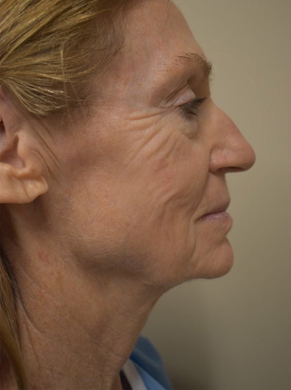 Facelift Before & After Gallery - Patient 312653 - Image 3