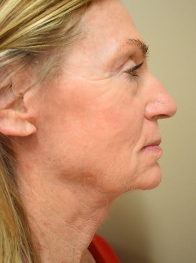 Facelift Before & After Gallery - Patient 312653 - Image 4
