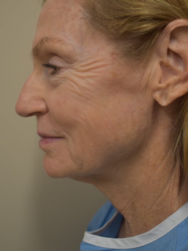 Facelift Before & After Gallery - Patient 312653 - Image 5