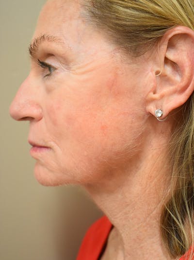 Facelift Before & After Gallery - Patient 312653 - Image 6