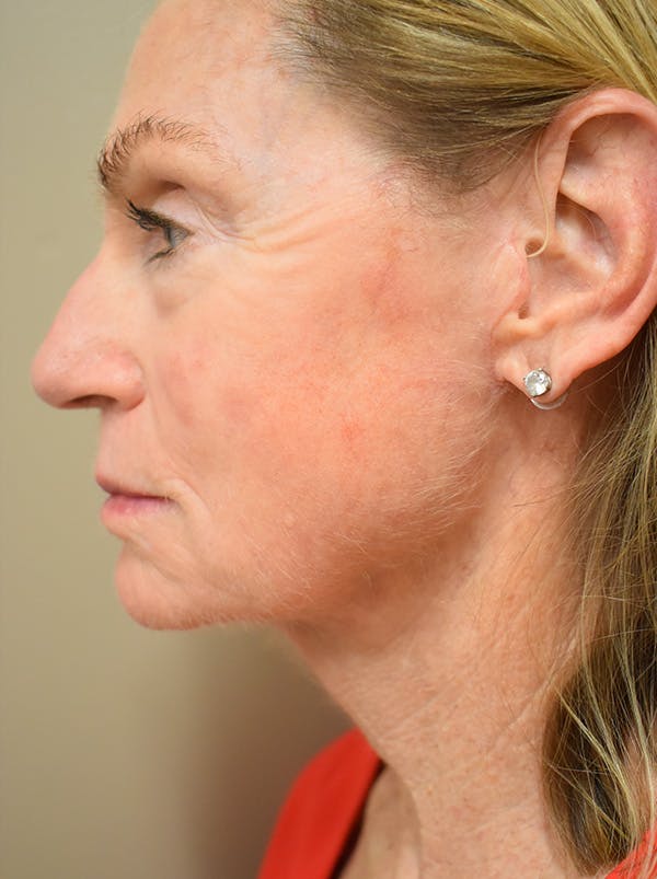 Facelift Before & After Gallery - Patient 312653 - Image 6