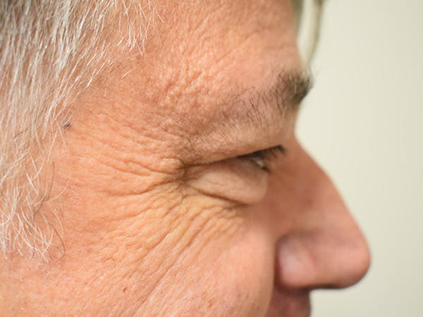 Eyelid Surgery Before & After Gallery - Patient 206859 - Image 5