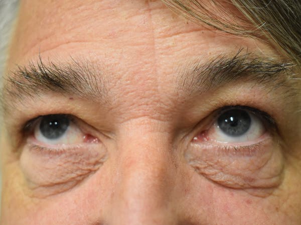 Eyelid Surgery Before & After Gallery - Patient 206859 - Image 1