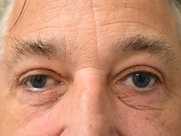 Eyelid Surgery Before & After Gallery - Patient 206859 - Image 2