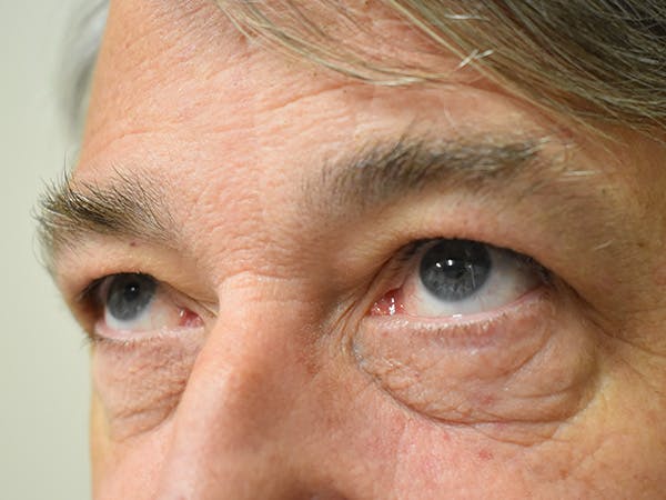 Eyelid Surgery Before & After Gallery - Patient 206859 - Image 3