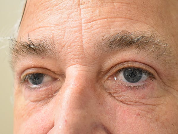 Eyelid Surgery Before & After Gallery - Patient 206859 - Image 4