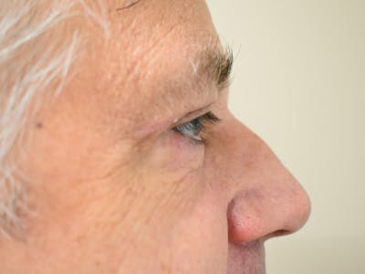Eyelid Surgery Before & After Gallery - Patient 206859 - Image 6