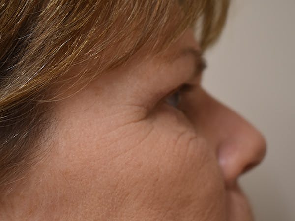 Eyelid Surgery Before & After Gallery - Patient 245237 - Image 4