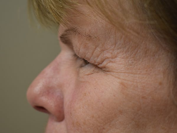 Eyelid Surgery Before & After Gallery - Patient 245237 - Image 5
