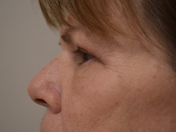 Eyelid Surgery Before & After Gallery - Patient 245237 - Image 6