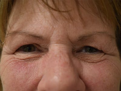 Eyelid Surgery Before & After Gallery - Patient 245237 - Image 1