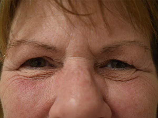 Eyelid Surgery Before & After Gallery - Patient 245237 - Image 1