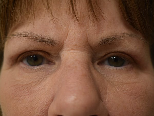 Eyelid Surgery Before & After Gallery - Patient 245237 - Image 2