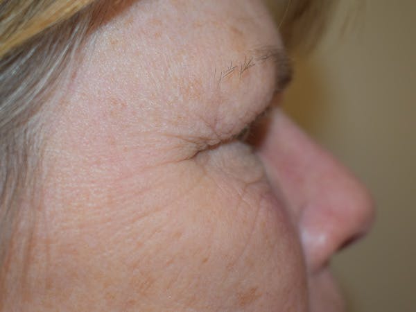 Eyelid Surgery Before & After Gallery - Patient 245237 - Image 3