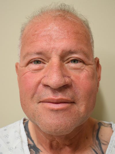 Facelift Before & After Gallery - Patient 312498 - Image 1