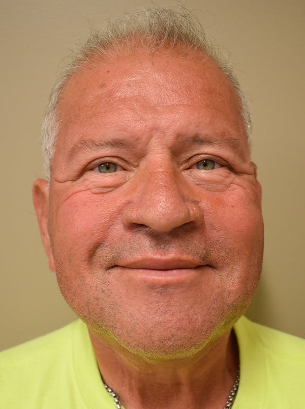 Neck Lift Before & After Gallery - Patient 281766 - Image 2