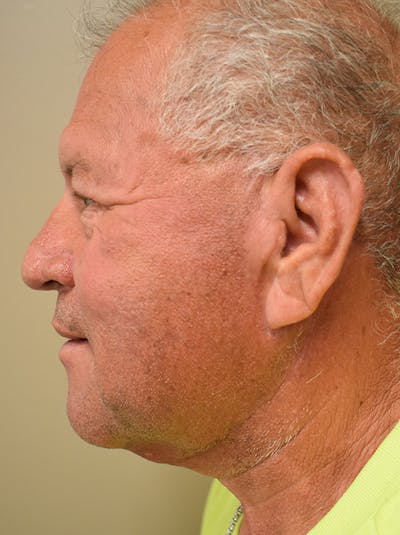 Neck Lift Before & After Gallery - Patient 281766 - Image 6