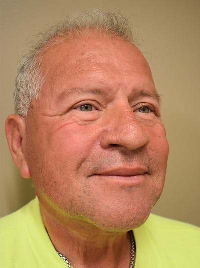 Neck Lift Before & After Gallery - Patient 281766 - Image 4